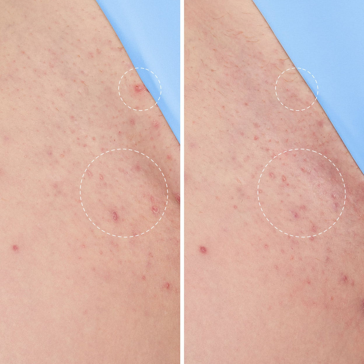 Smoothing Solution Ingrown Hair Treatment